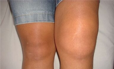 The causes of arthrosis of the knee joint
